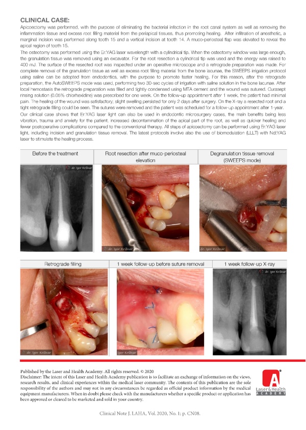 Apicoectomy – Chronic apical periodontitis treatment