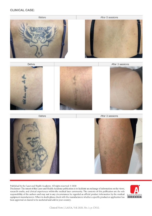 FracTAT™ Tattoo Removal