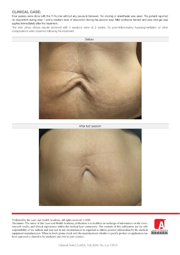 Combined Er:YAG and Nd:YAG Laser Skin Tightening Treatment
