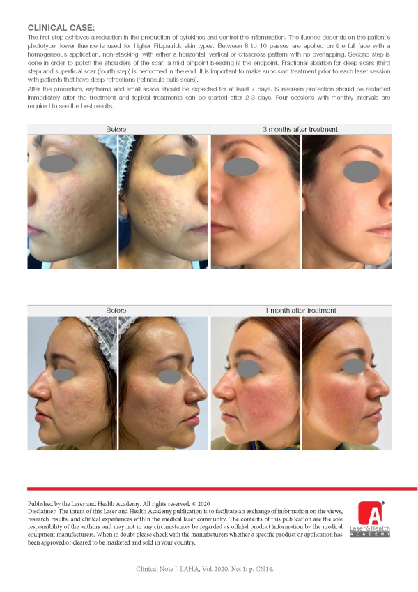 Laser Treatment for Acne Scars with Fractional Er:YAG and Nd:YAG Laser