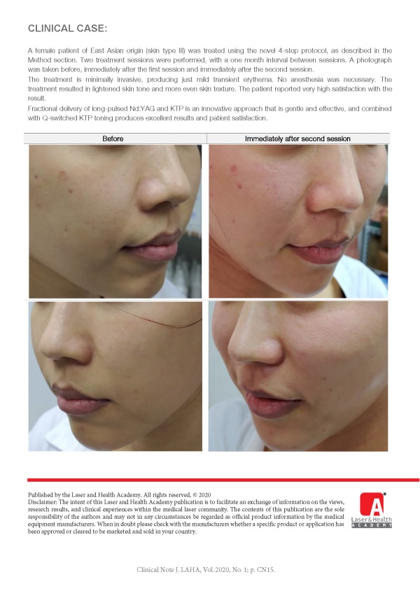 StarWalker® MaQX-Tone™ Treatment for Toning, Whitening and Rejuvenation in Asian skin