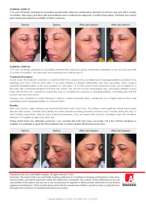 Alternative Laser Protocols for the Treatment of Actinic Lichen Planus