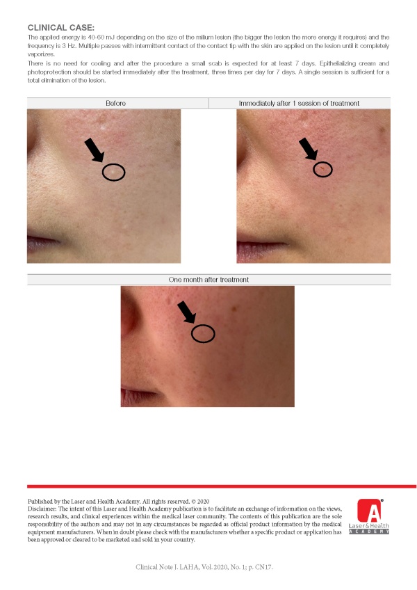 Treatment of Milia with Er:YAG Laser