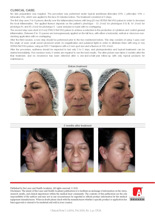 Laser Treatment for Granulomatous Rosacea with Nd:YAG (1064 nm) Laser