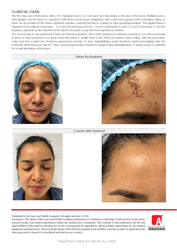 Laser treatment for Verrucous Epidermal Nevus with Er:YAG laser