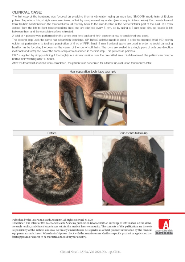 Treatment of Androgenetic Alopecia (AGA) Combining HaiRestart and PRP Application