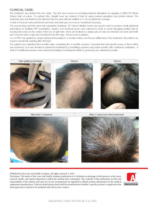 Combination of Plasma Rich Platelet (PRP) with HaiRestart Er:YAG laser for the treatment of Alopecia Areata.  