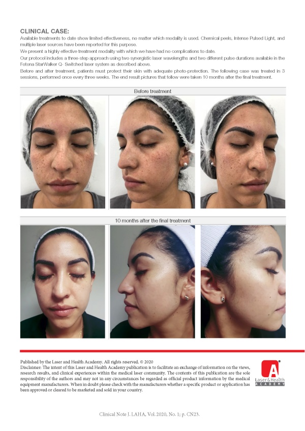 Highly Effective 3-Step, Dual-Wavelength Multipulsed Freckle Treatment with Fotona StarWalker System
