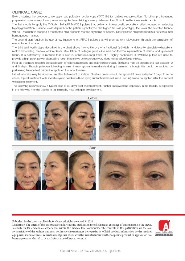 Simultaneous Hyperpigmentation, Pores and Rhytids Treatment with Multi-pulse Nd:YAG Laser