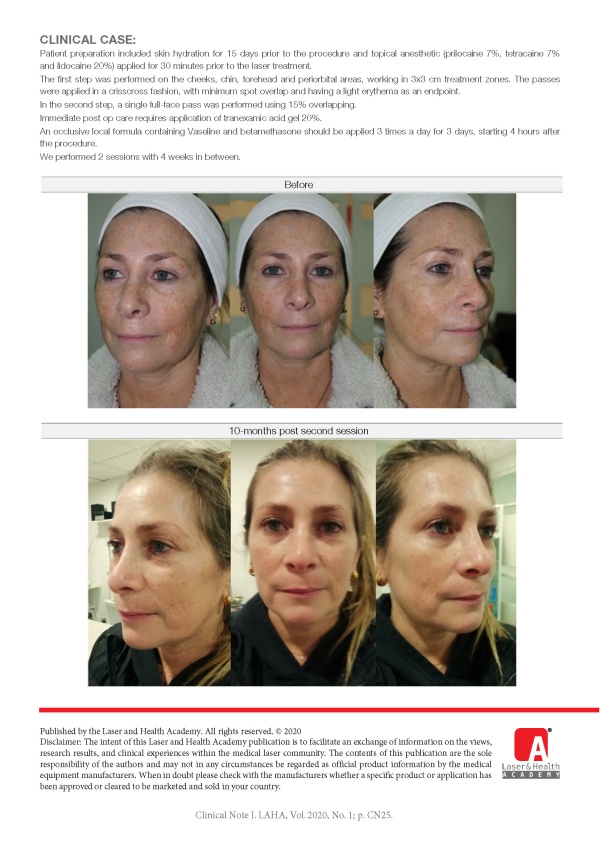 Facial Rejuvenation with the StarWalker MaQX Laser