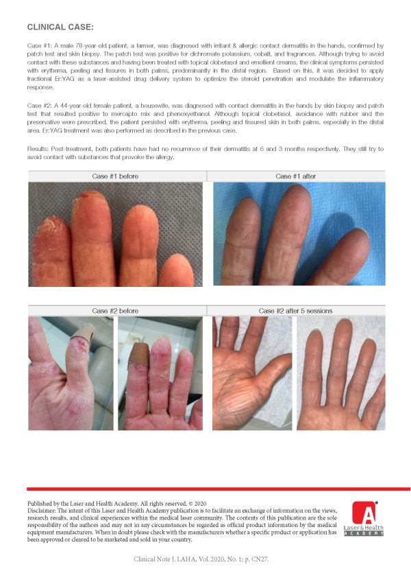Allergic Contact Dermatitis Treated with LADD (Laser Assisted Drug Delivery) Protocol