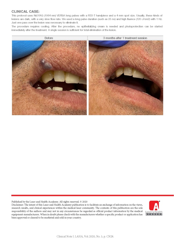 Venous Lake Treatment with Nd:YAG Laser 